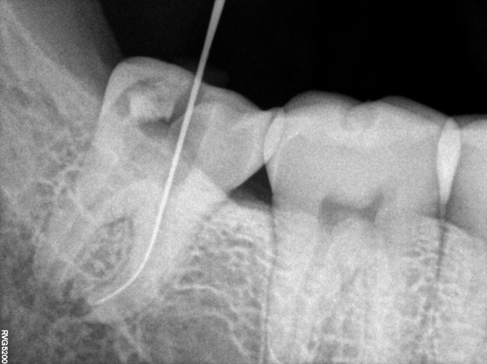 Dental X-ray